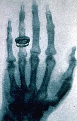 German physicist Wilhelm Rontgen took this X-ray during a public lecture in 1896. Public domain image.