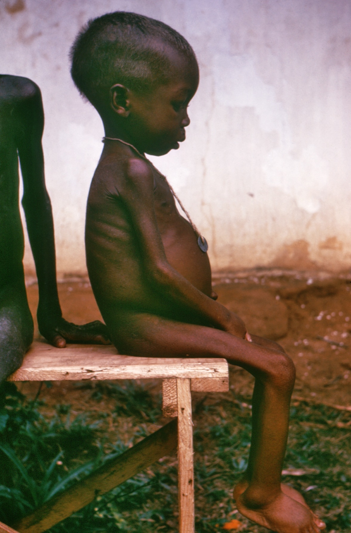 A child with kwashiorkor. Photo taken during a conflict in Nigeria in the 1960's. 