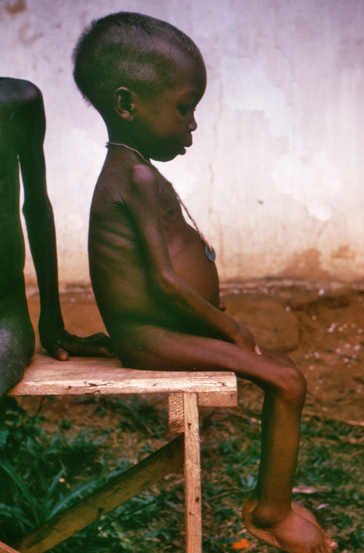 A child with kwashiorkor. Photo taken during a conflict in Nigeria in the 1960's.