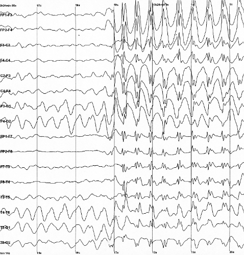 EEG of a petit mal seizure.