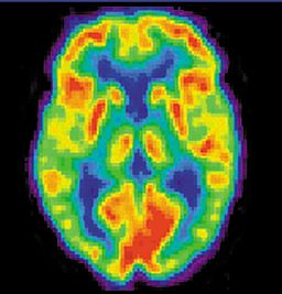 PET image of a human brain