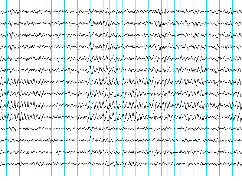This shows typical brain wave patterns.
